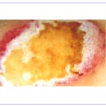 What Does a Burn Degree Chart Reveal? Full Burn Guide & Recovery