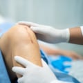 How Long Do Dissolvable Stitches Last? A Guide to Healing and Monitoring With PCR Testing