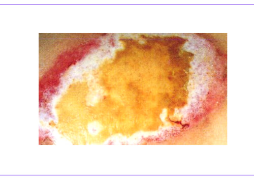 What Does a Burn Degree Chart Reveal? Full Burn Guide & Recovery